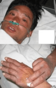 Hisashi Ouchi Real Photos: A Harrowing 83 Days of Death from Radiation